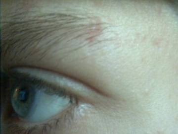 eyebrow scar